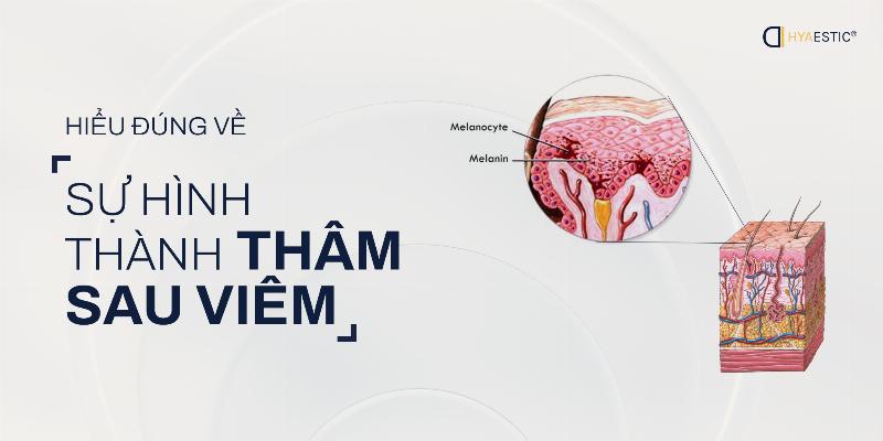 Hình ảnh minh họa các loại thâm mụn phổ biến: tăng sắc tố sau viêm (PIH) và ban đỏ sau viêm (PIE)